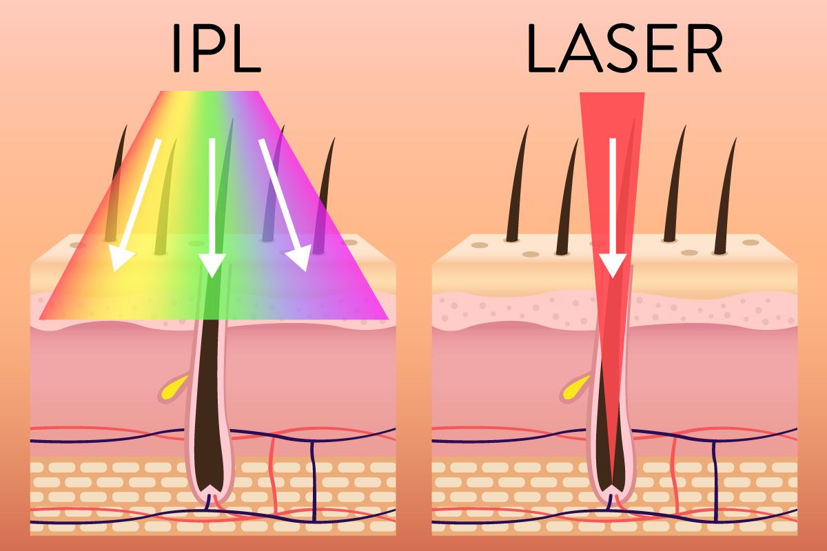 Unterschied zwischen IPL und Laser
