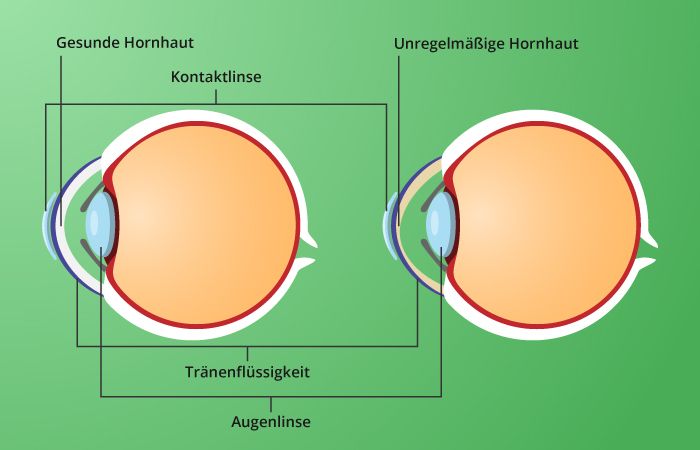Korrekturprinzip von Kontaktlinsen